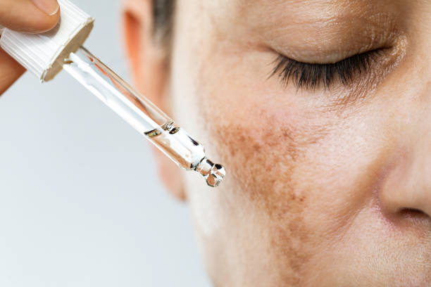 does red light therapy fade melasma