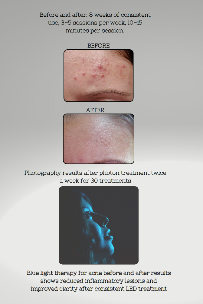 Before and after results of blue light therapy for acne on a person's face. 2.