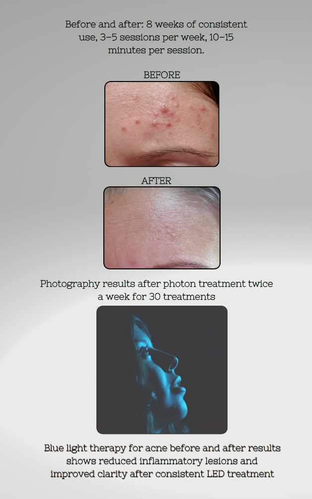 Before and after results of blue light therapy for acne on a person's face.