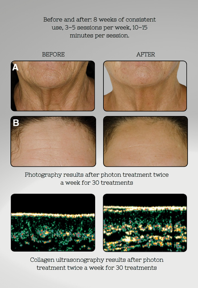Before and after skin treatment results with photon therapy, showing skin texture and collagen ultrasonography images.