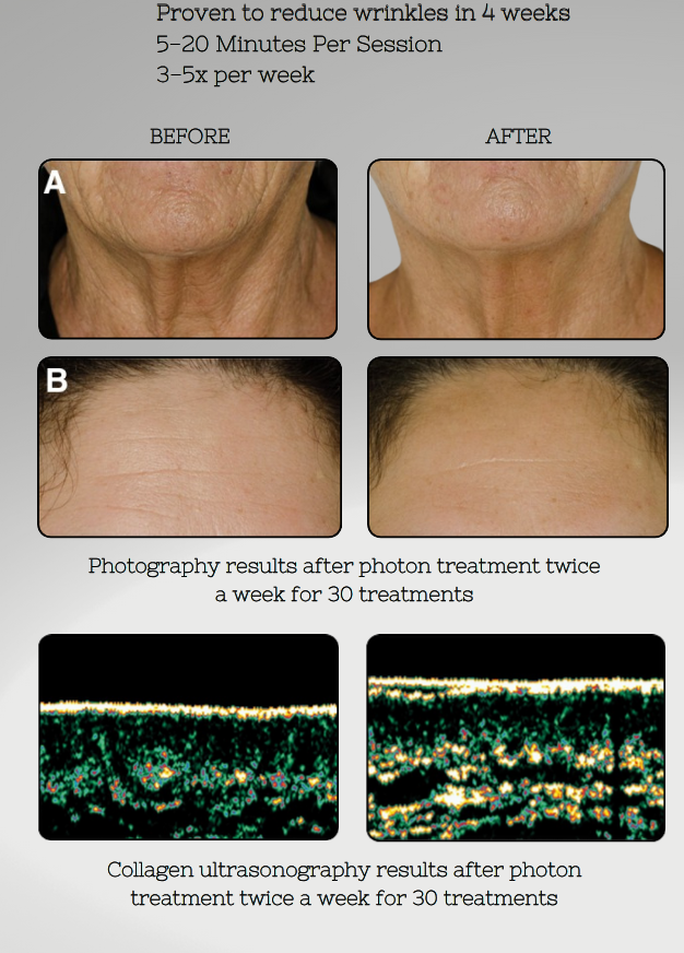 Before and after results of a skin treatment with photonic therapy, showing skin texture and collagen ultrasonography images.